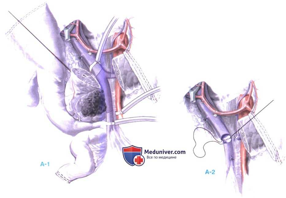 Колостомия: уход за колостомой, показания к колостоме кишки, техника выполнения операции | клиники «евроонко»