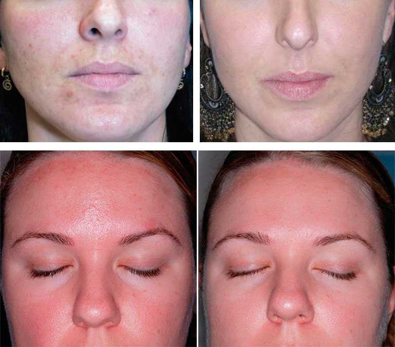 Как пилинг гликолевой кислотой справляется с несовершенствами кожи | блог expert clinics