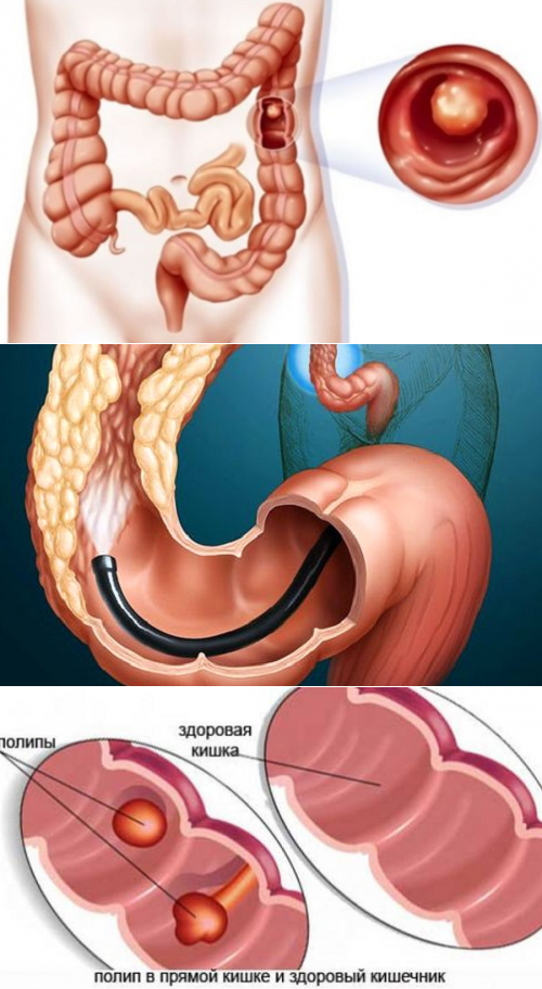 Эндоскопическая полипэктомия - удаление полипов желудка и кишечника