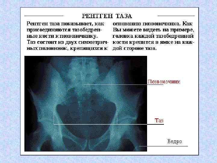 Рентген костей таза