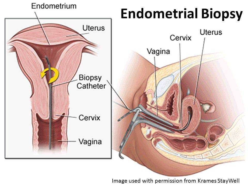 Пайпель-биопсия эндометрия матки, показание и проведение гистологического исследования
