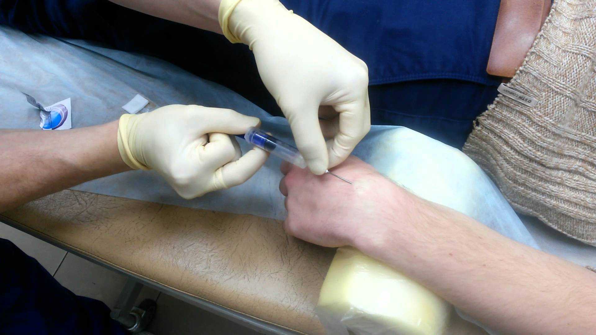 Гигрома / ганглий лучезапястного сустава кисти – лечение, операция по лазерному удалению / иссечению, реабилитация – травматология цкб ран