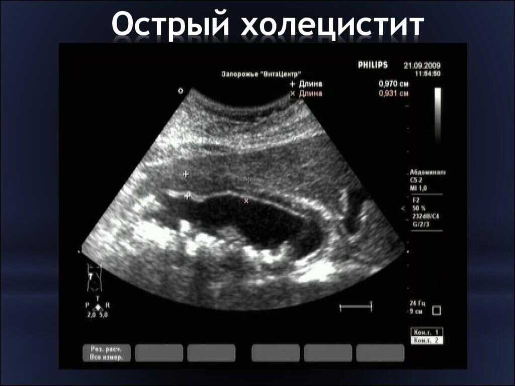 Острый холецистит картинки