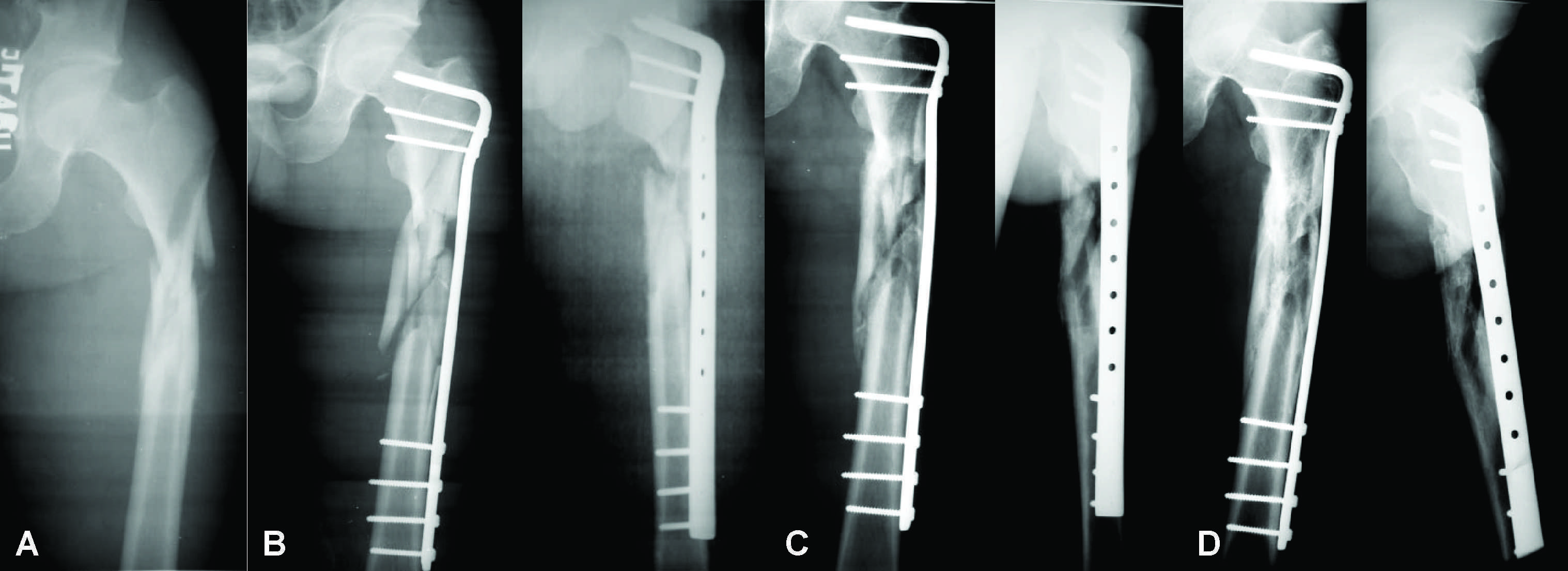 Особенности реабилитации после остеосинтеза бедренной кости, плечевой кости и голени