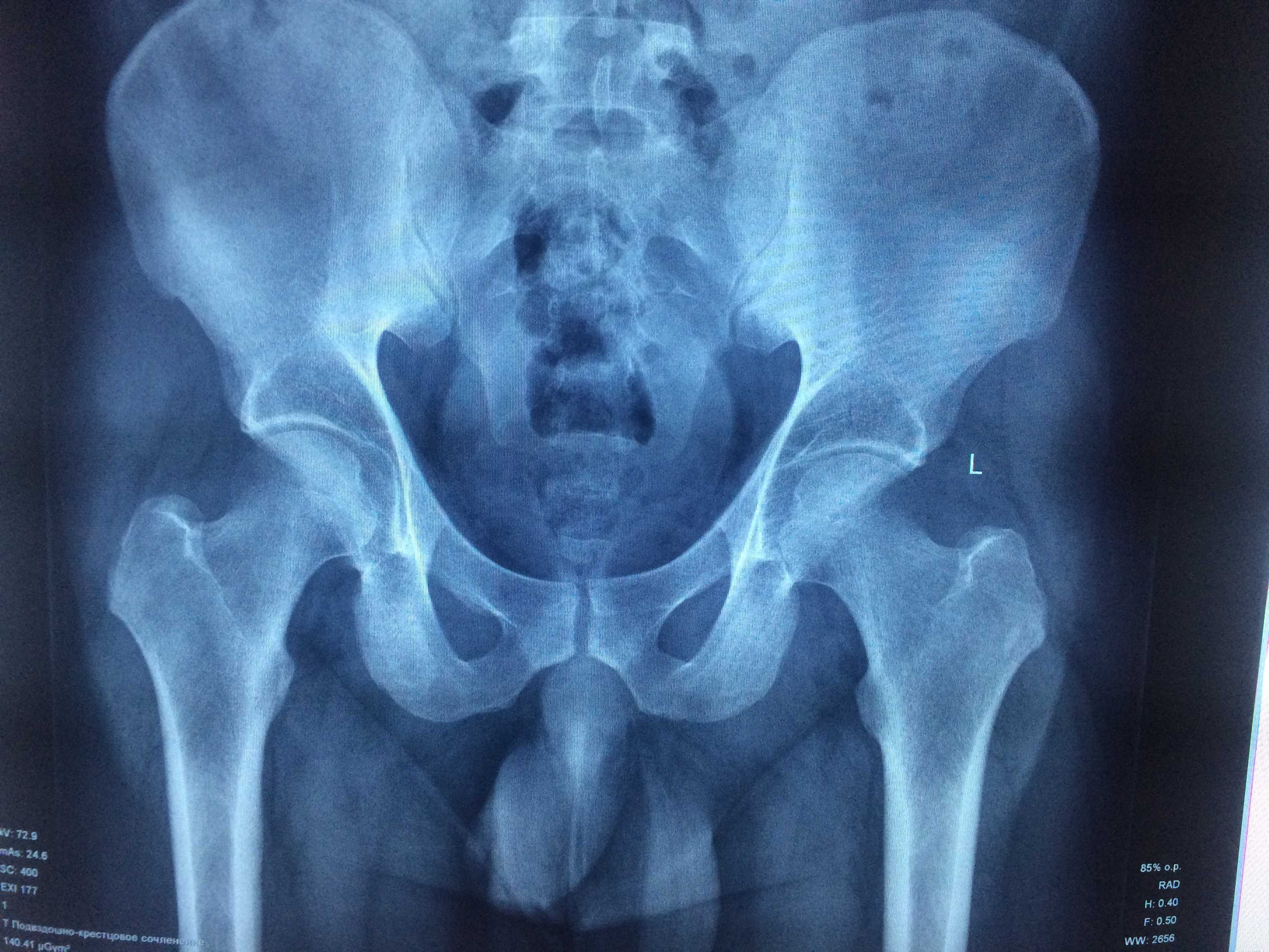 Рентген тазобедренного сустава: подготовка и проведение в отличии от мрт