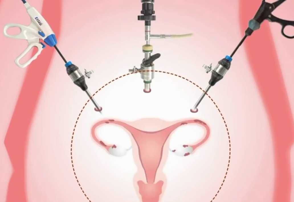 Операция при опущении и выпадении матки