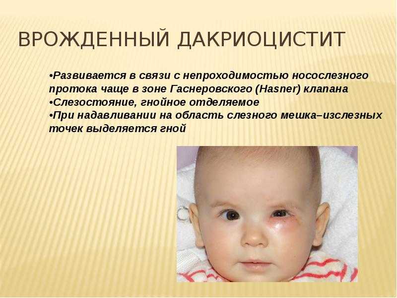 Воспаление слезного канала: 5 способов лечения, симптомы и фото