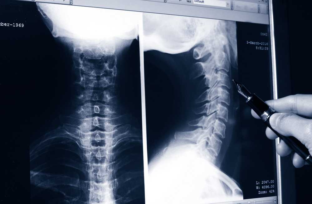Рентген шейного отдела позвоночника - как проводится процедура?