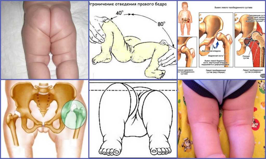 Дисплазия тазобедренных суставов у детей, лечение и симптомы