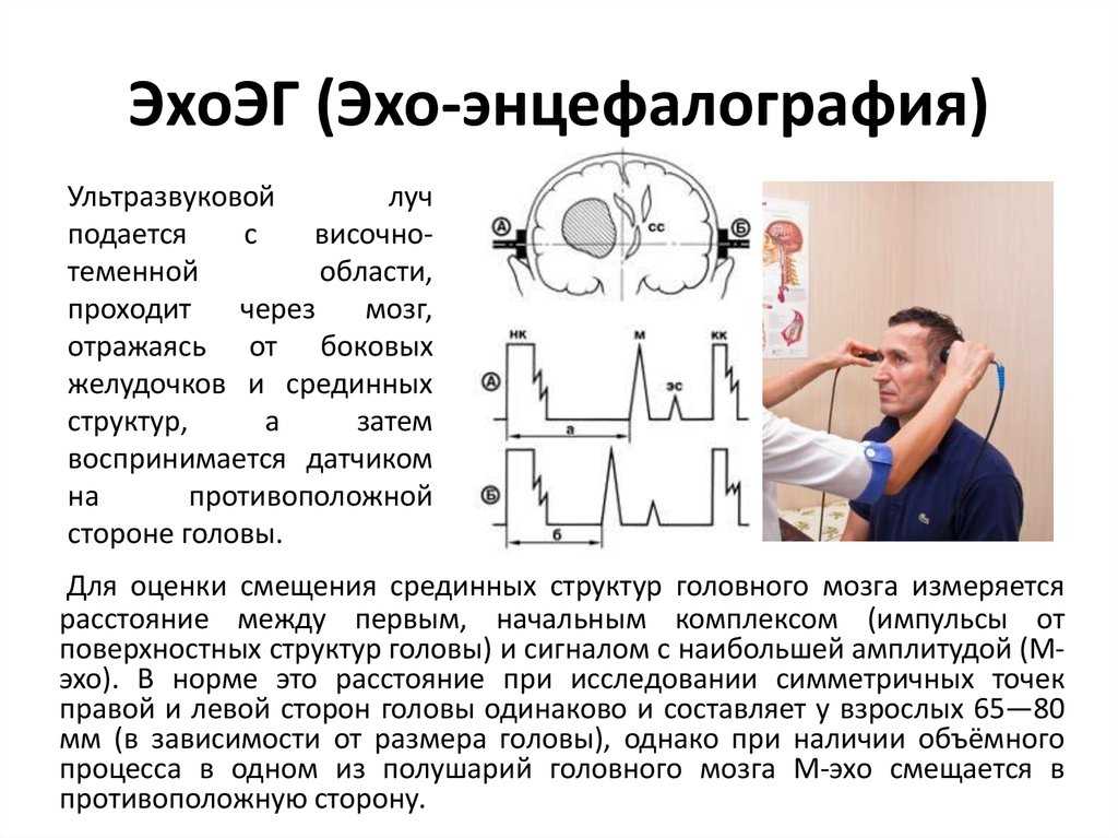 Энцефалограмма головного мозга: что такое электроэнцефалография, что показывает, для чего делают, подготовка к процедуре, противопоказания