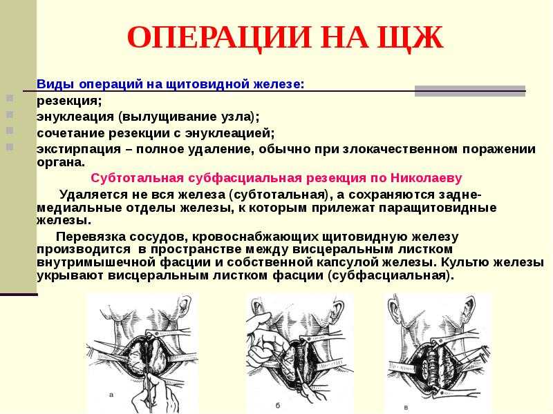 Резекция доли щитовидной железы. Субтотальная резекция щитовидной железы схема. Техника субтотальной субфасциальной резекции щитовидной железы. Резекция щитовидной железы этапы операции. Субтотальная субфасциальная резекция.