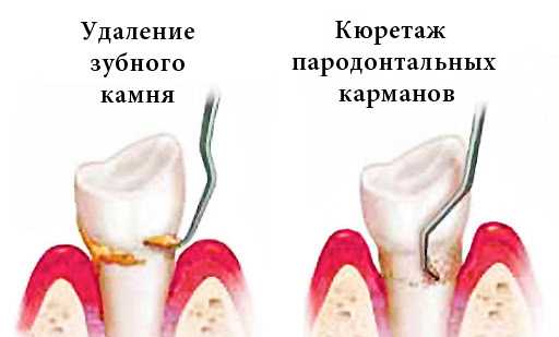 Что делать после удаления зуба?