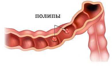 Полипы желудка - являются ли признаком рака желудка