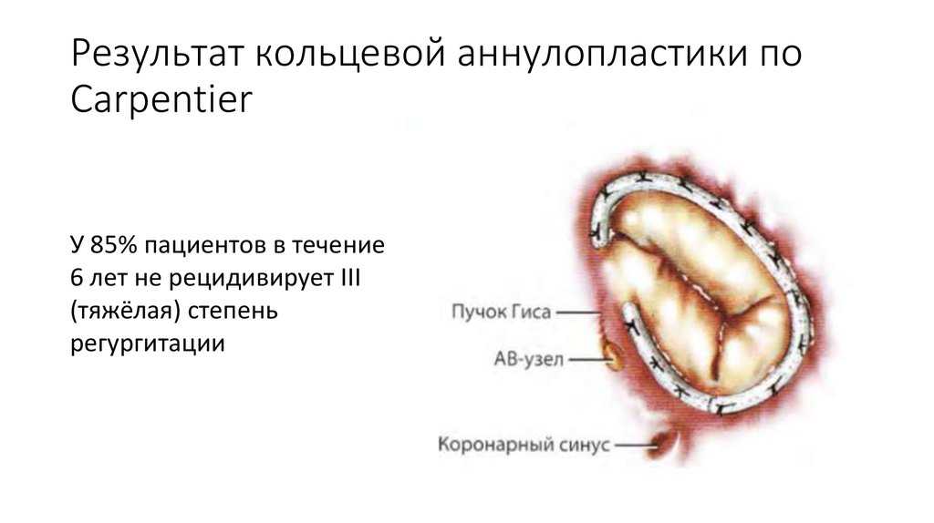 Транскатетерное протезирование аортального клапана (tavi)
