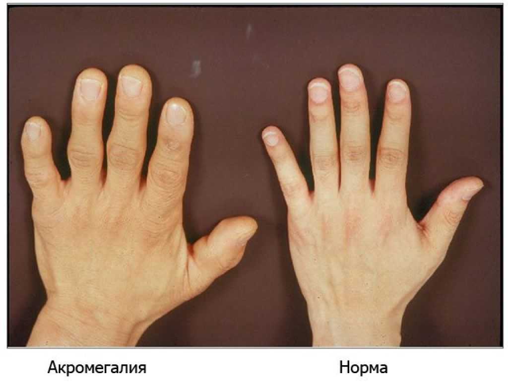 Увеличение рук
