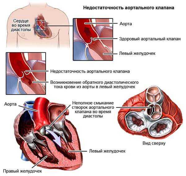 Замена митрального и аортального клапанов