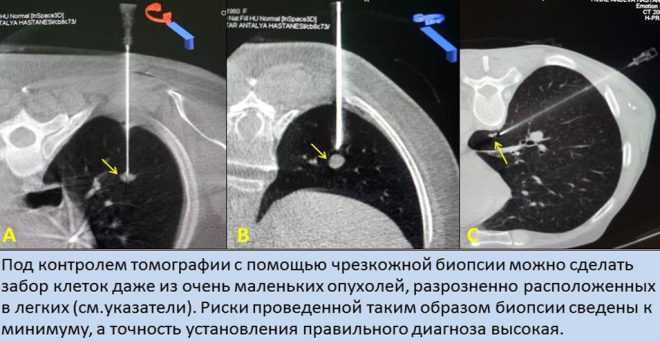 Что такое биопсия почки? особенности выполнения и значение почечной биопсии * клиника диана в санкт-петербурге