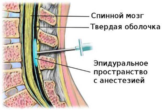 Эпидуральная спинная. Эпидуральное пространство спинного мозга. Субдуральная и эпидуральная анестезия. Эпидуральная блокада грыжи. Спинномозговая анестезия оболочки.