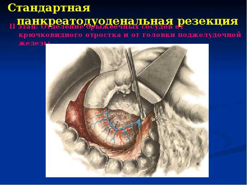 Удаление матки: особенности операции и послеоперационного периода