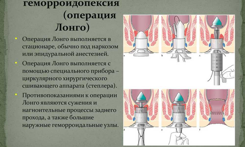 План лечения геморроя