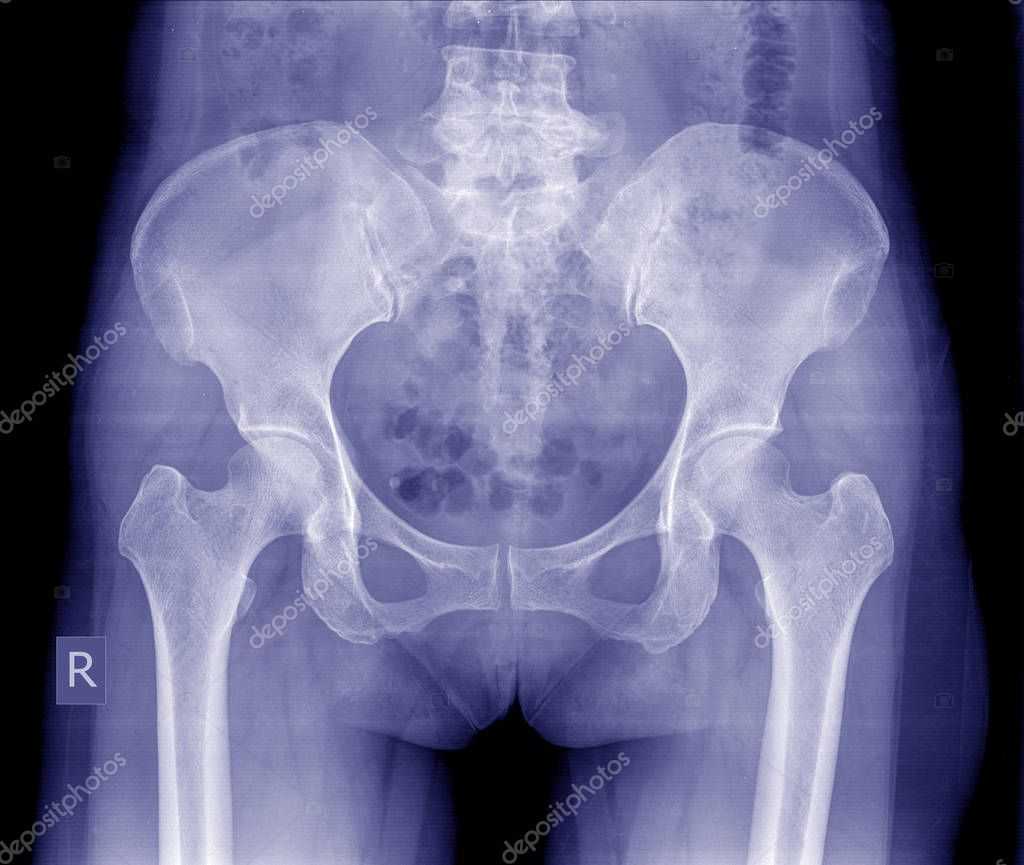 Что такое сцинтиграфия костей скелета: как проводится рентген костей и суставов при раке | клиники «евроонко»