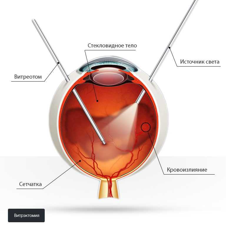 Макулярный разрыв: причины, симптомы, реабилитация | офтальмологическая глазная клиника "нью вижн"