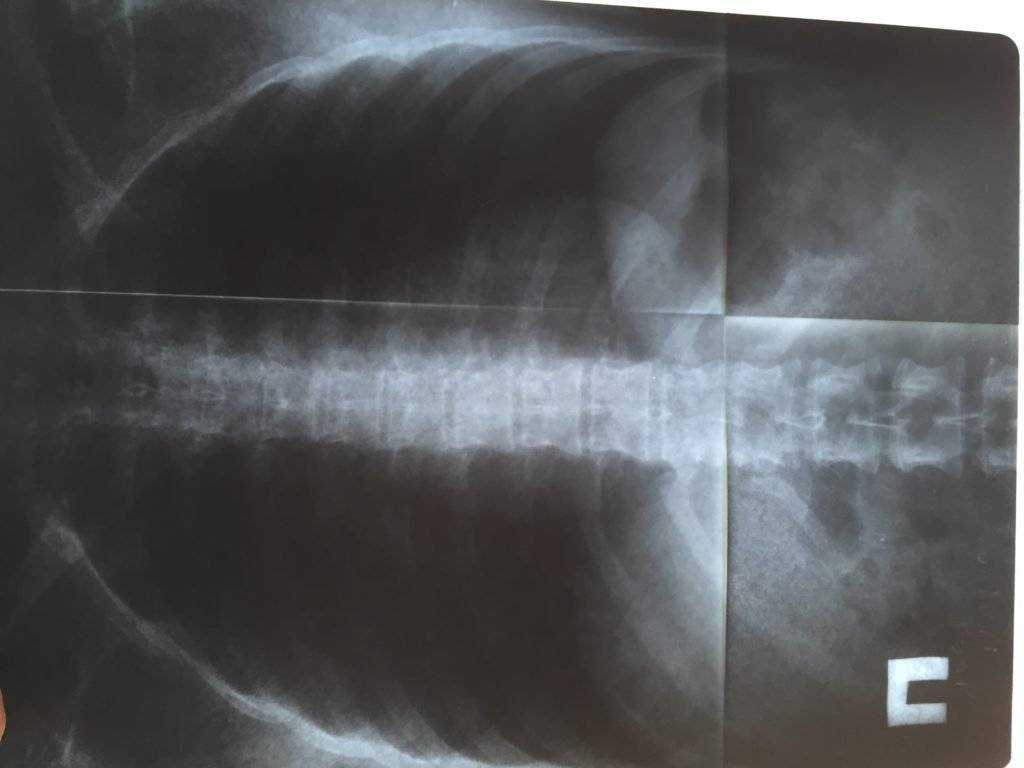 Рентгенологическая диагностика давности переломов ребер