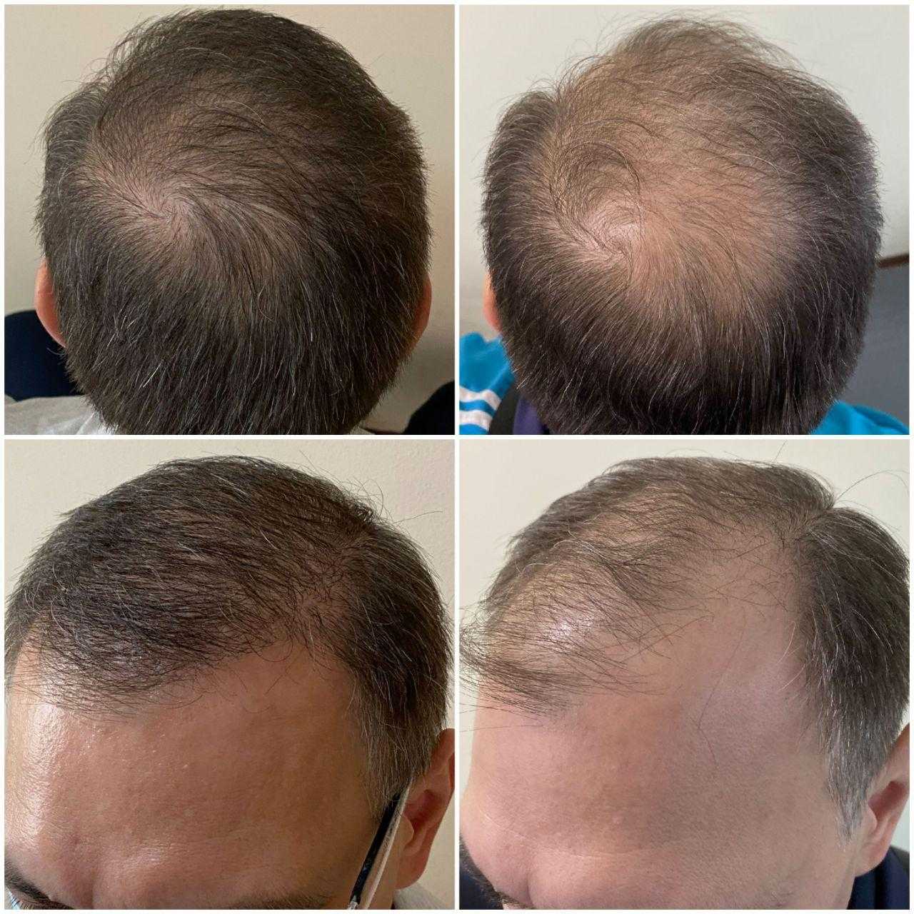 Пересадка волос екатеринбург. Графт трансплантация волос. Пересадка волос до и после. Трансплантация волос методом fue.
