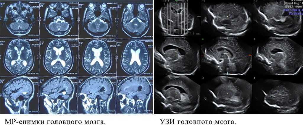 Что лучше мрт или узи головного мозга. Что такое кт мрт и УЗИ, отличия. Снимок головного мозга. Снимки мрт головного мозга.