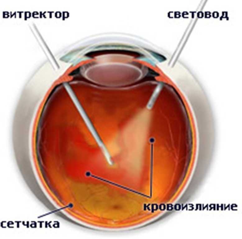 Микроинвазивная витрэктомия: стоимость операции на глаза, что делать в период восстановления