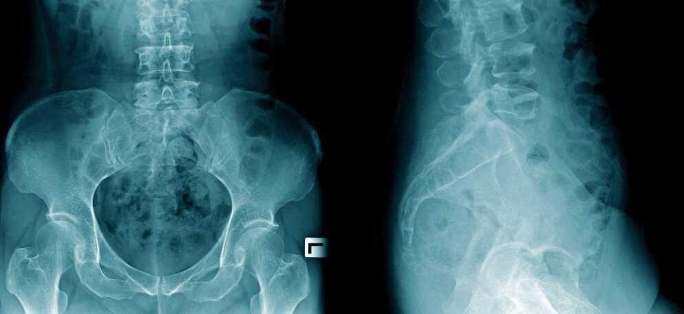 Как часто можно делать рентген легких без вреда