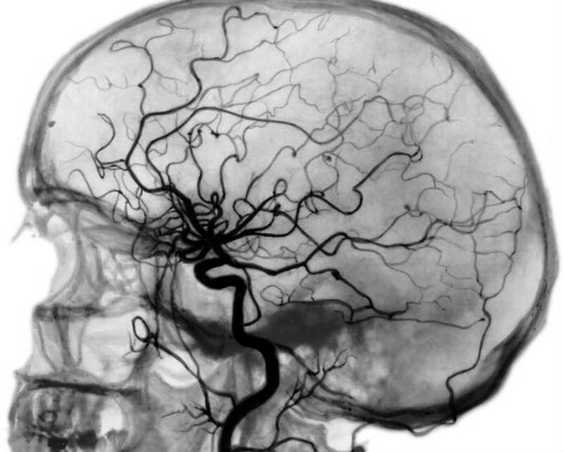 Кт (компьютерная томография) головного мозга: что показывает | кт ангиография