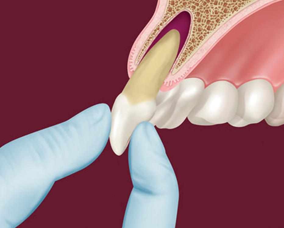 Осложнения после удаления зуба: какие бывают, как их избежать | стоматология дентоспас