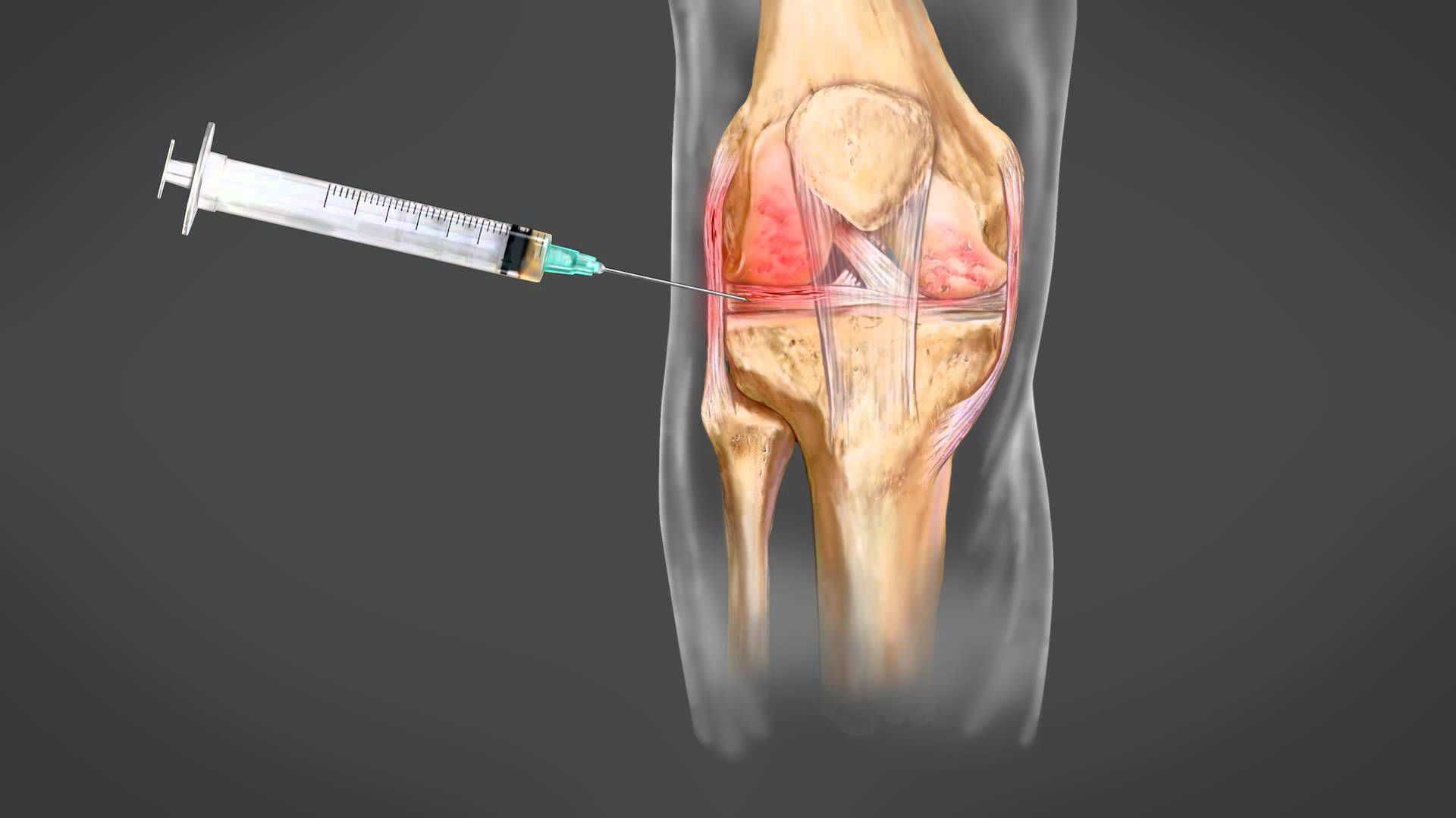 Рентген (рентгенография) коленного сустава: схема проведения | food and health