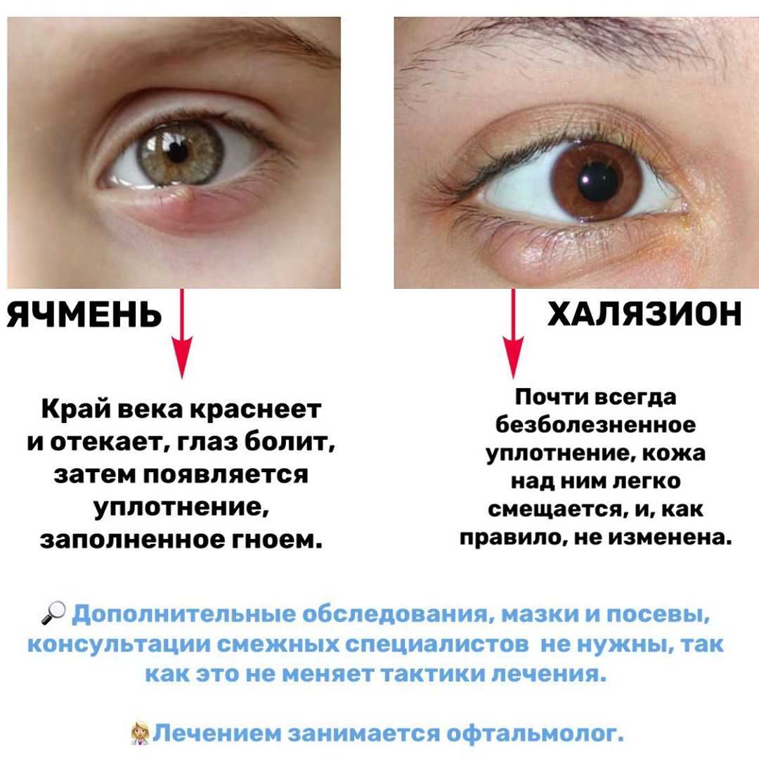 Зондирование слезного канала у новорожденных и детей до года: видео, последствия операции