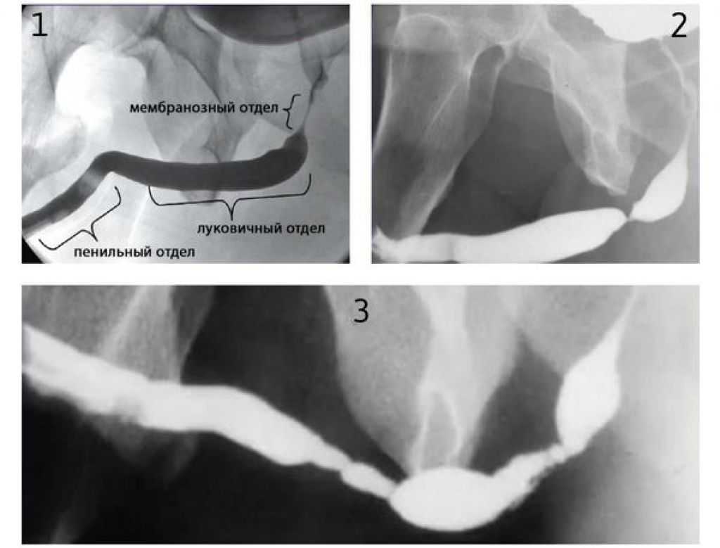 Стриктура уретры. Стриктура уретры рентген. Стриктура мембранозного отдела уретры. Посттравматическая стриктура уретры. Стриктура уретры уретрография.