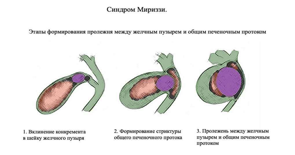 Синдром мириззи презентация