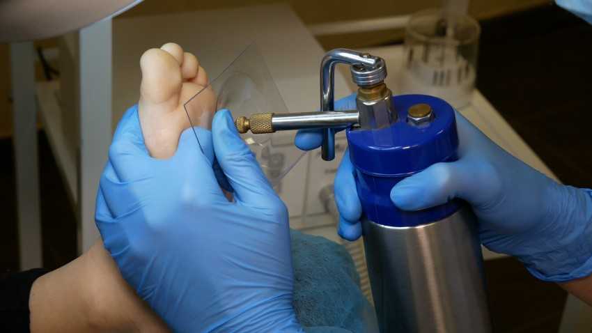 Криодеструкция жидким азотом как метод удаления новообразований кожи