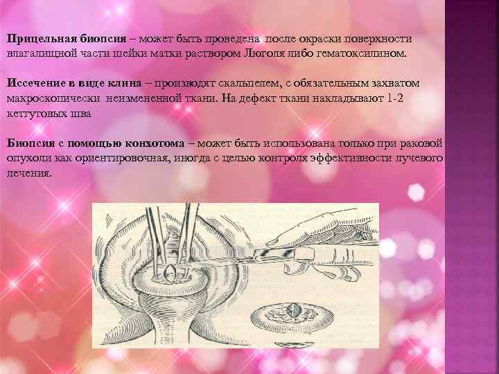Кольпоскопия шейки матки с биопсией: ответы на вопросы читательниц * клиника диана в санкт-петербурге