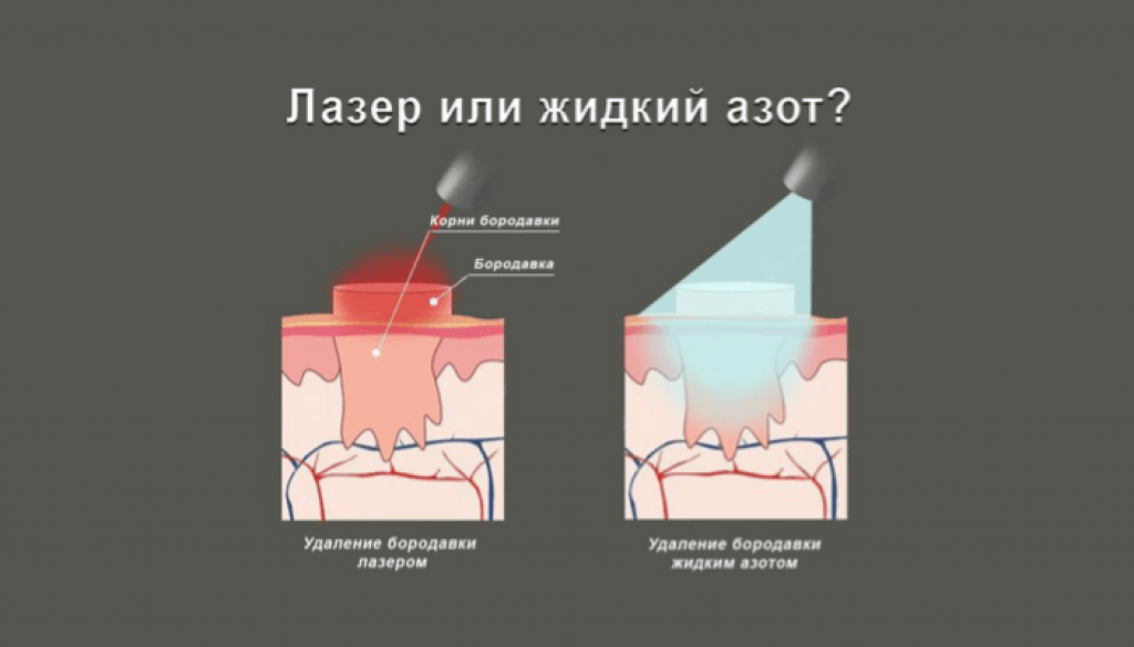 Криодеструкция жидким азотом как метод удаления новообразований кожи