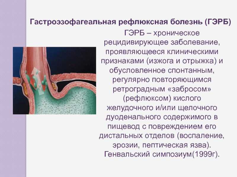 Гастроэзофагеальная рефлюксная болезнь: новый подход к причинам и лечению * клиника диана в санкт-петербурге