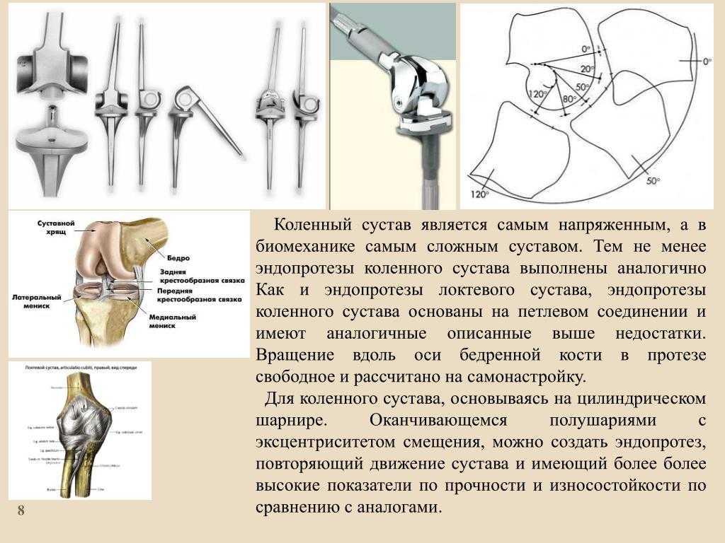 Замена коленного сустава в россии