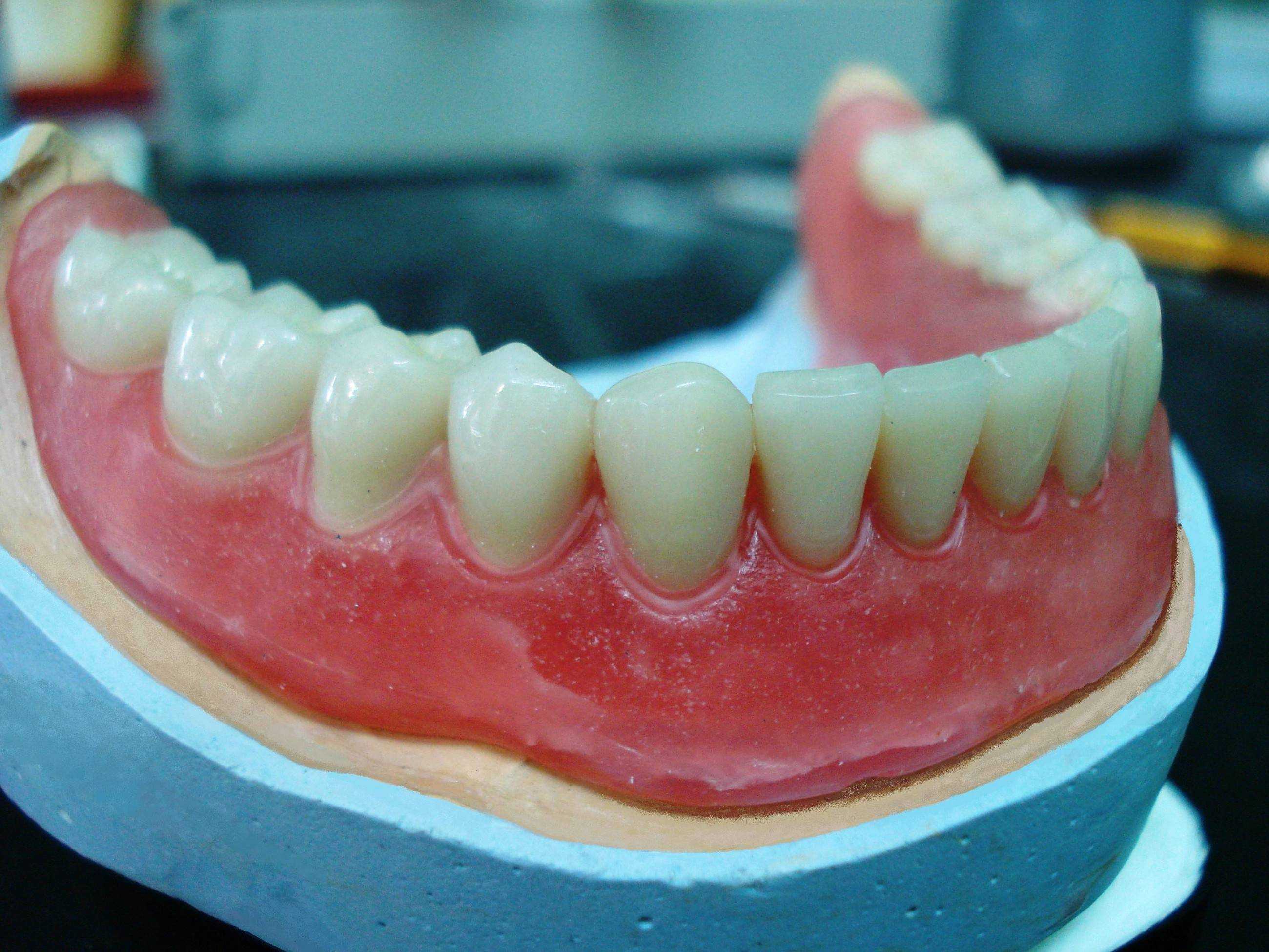 Нижний протез зубов какой. Моделировка базиса нижней челюсти. Съемный пластиночный протез.