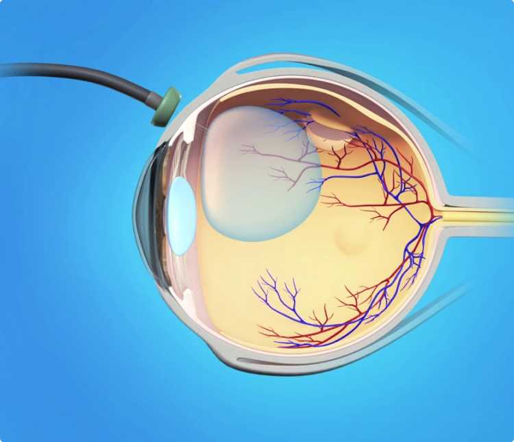 Витрэктомия (витреоэктомия) глаза – операция по удалению стекловидного тела – клиника «новый взгляд»