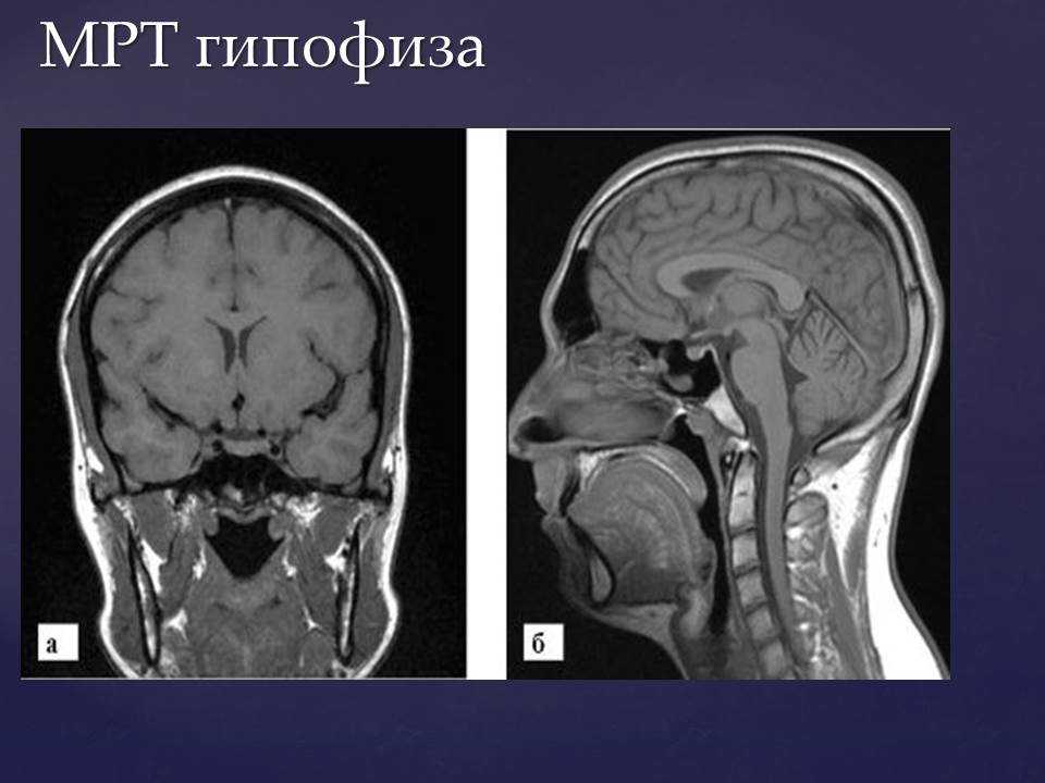 Мрт гипофиза в москве — цена на томографию гипофиза в многопрофильная клиника «союз»