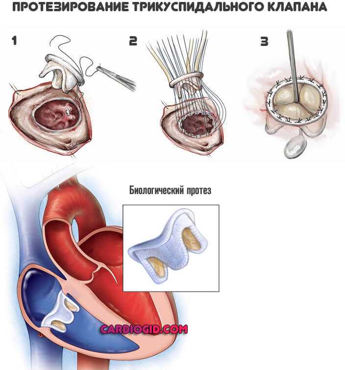 Коронарная ангиопластика и стентирование коронарных артерий