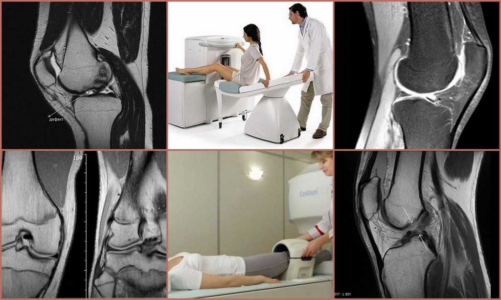 Перелом предплечья. причины перелома, перелом со смещением, перелом лучевой кости, перелом локтевой кости