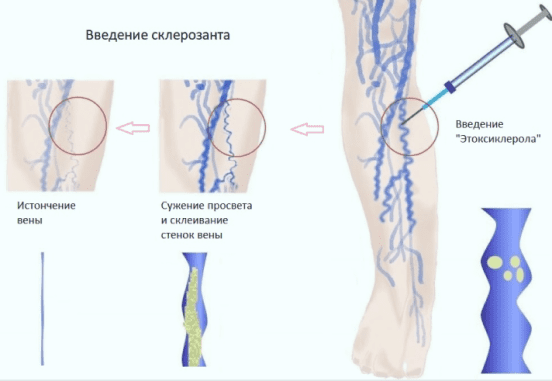 Склеротерапии вен нижних конечностей