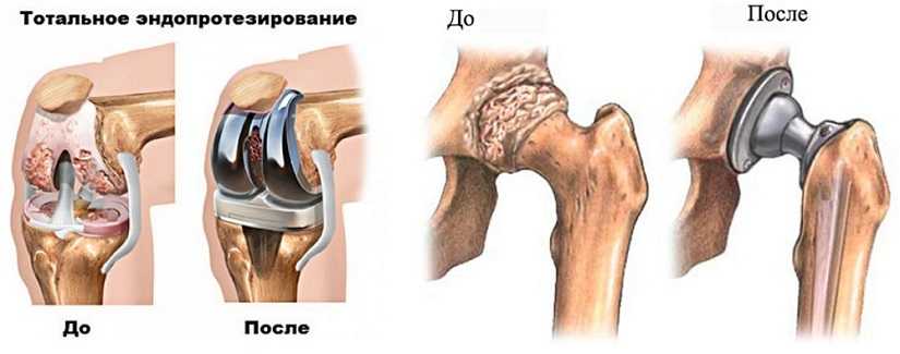 Тазобедренный сустав операция показать. Эндопротезирование коленного и тазобедренного сустава. Тазобедренный эндопротез Stryker. Тотальное эндопротезирование сустава. Одномыщелковое эндопротезирование коленного сустава.