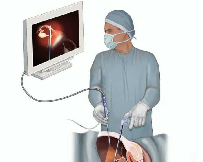 Лапароскопия при непроходимости маточных труб